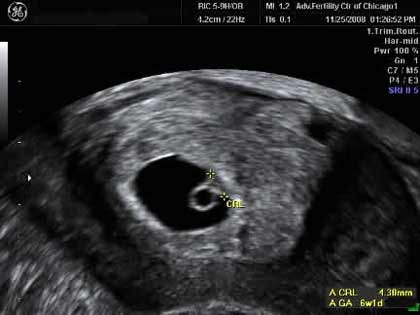 6 Weeks Pregnant Symptoms, Ultrasound, Cramping - What To ...