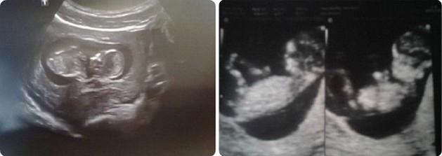 12 weeks pregnant ultrasound