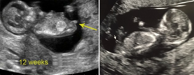 12 Weeks Ultrasound Boy