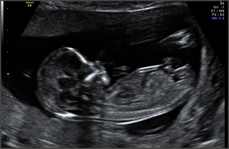 13-weeks-pregnant-fetus-and-ultrasound