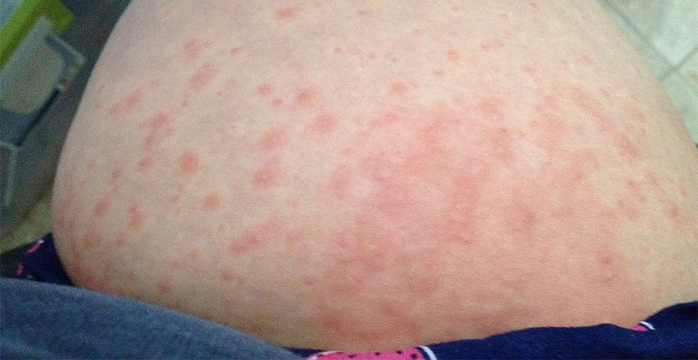 skin rash during pregnancy