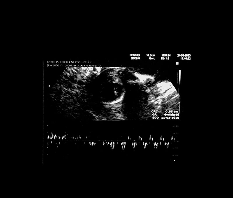 1 Month Pregnant Ultrasound, Symptoms, Belly & Baby Sonogram