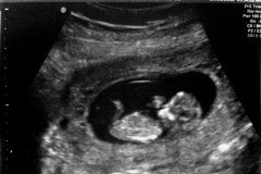ultrasound at 11 weeks