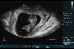week 11 ultrasound