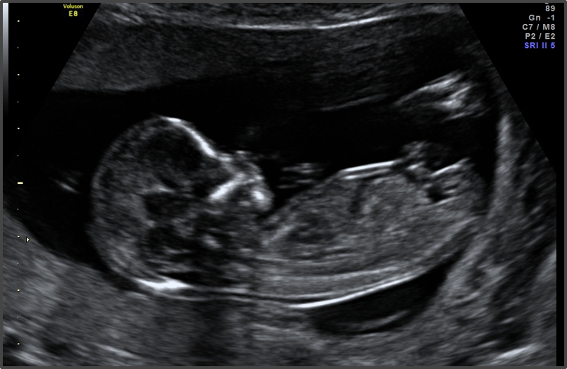 13 week Ultrasound.