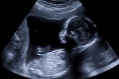 13 week ultrasound