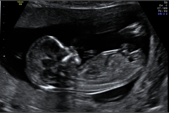 happy week 13 ultrasound