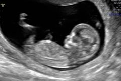 week 13 ultrasound