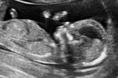 week 13 ultrasound