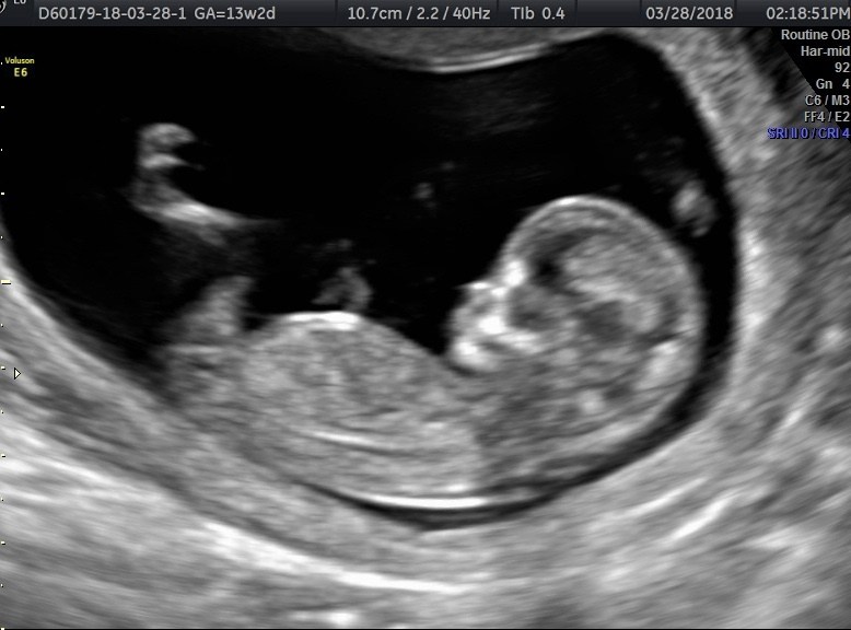 13-weeks-pregnant-symptoms-ultrasound-belly-baby-development