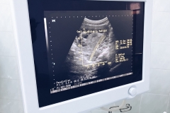 Week 14 Pregnancy Ultrasound