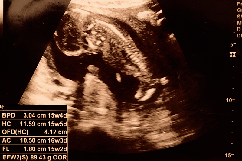 Week 15 Pregnancy Ultrasound