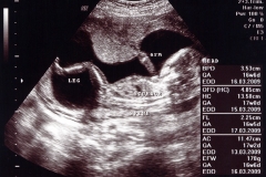 17 Week Ultrasound 1