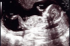 17 Week Ultrasound 2