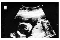 17 Week Ultrasound