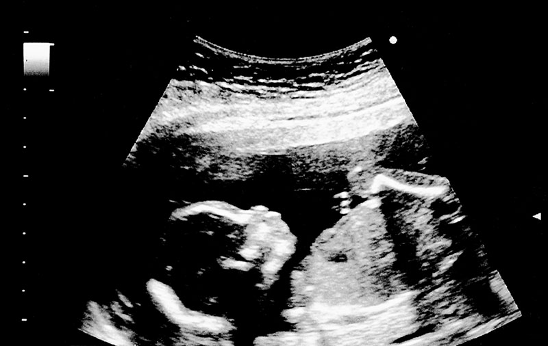 18 Weeks Pregnant Symptoms, Ultrasound and Fetus Development