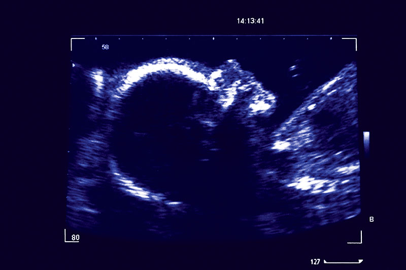 26 Weeks Pregnant Fetus Symptoms Ultrasound What To Expect