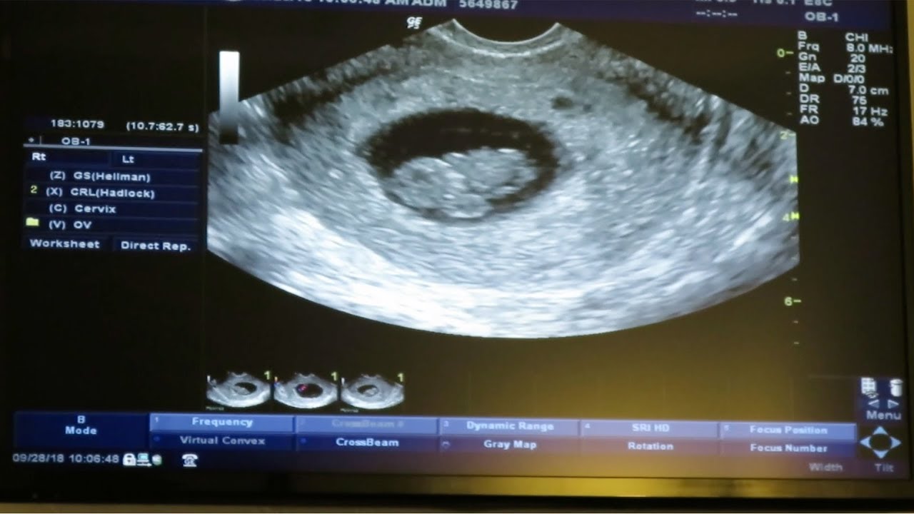 9 Weeks Pregnant Symptoms, Ultrasound, Belly, Baby Development