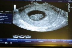 9 week ultrasound