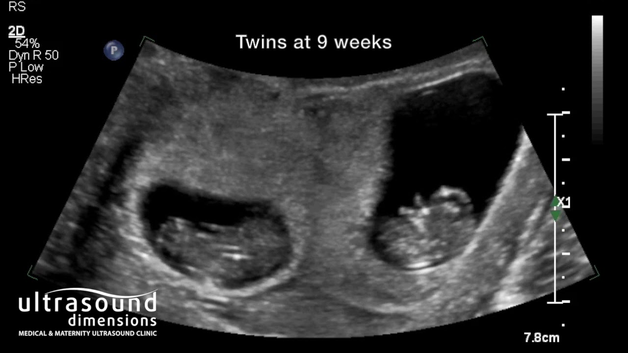 9 Weeks Pregnant Symptoms Ultrasound Belly Baby Development
