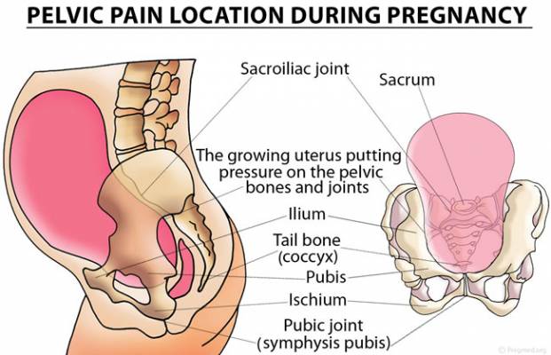 Pelvic Pain Location in Pregnancy