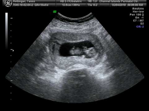 10 Weeks Pregnant Ultrasound, Symptoms, Baby Development