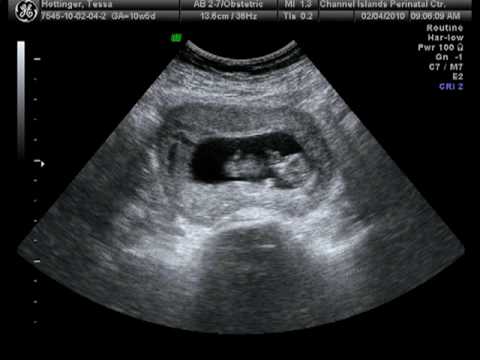 10 Weeks Pregnant Ultrasound 10 Weeks Pregnant Ultrasound