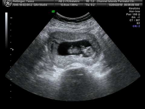 10 Weeks Pregnant Ultrasound