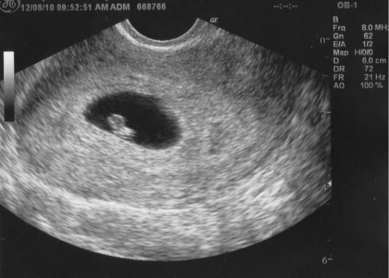 6 Weeks Pregnant Symptoms, Ultrasound, Spotting and Cramping
