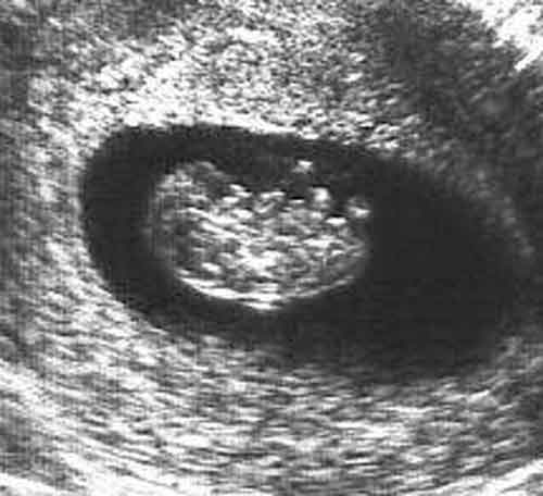 8 Weeks Pregnant Utrasound