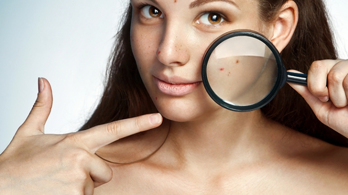 Treat Acne During Pregnancy