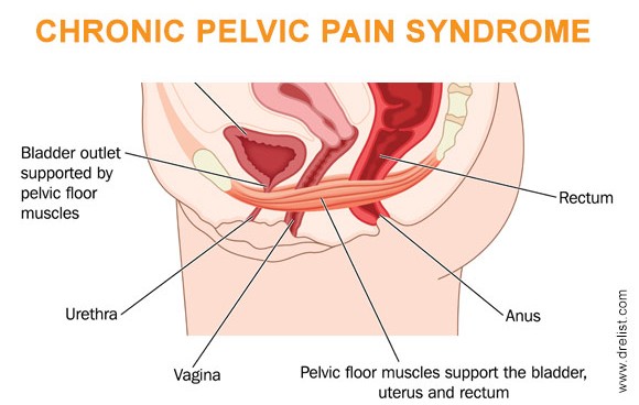 Chronic Pelvic Pain Syndrome