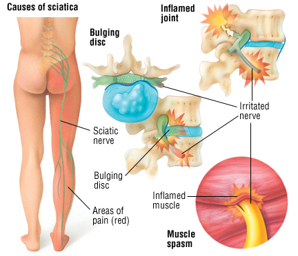 Causes of Sciatica Pain
