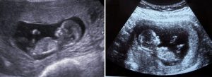 11 weeks pregnant ultrasound what to expect