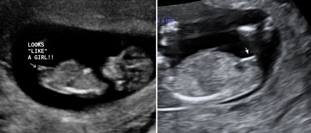 12 Weeks Ultrasound Girl