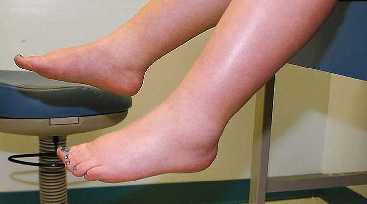 Swelling During Pregnancy