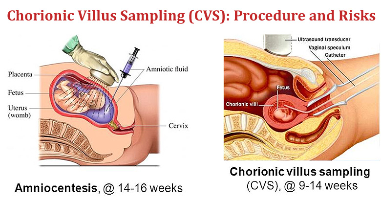 Chorionic Villus Sampling (CVS): Procedure and Risks