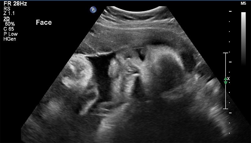 8 Months Pregnant Ultrasound